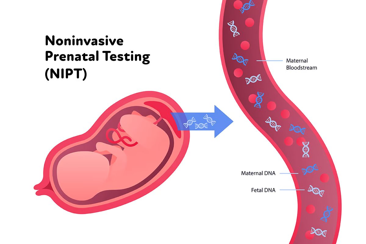 NIPT (Non - Invasive prenatal test)