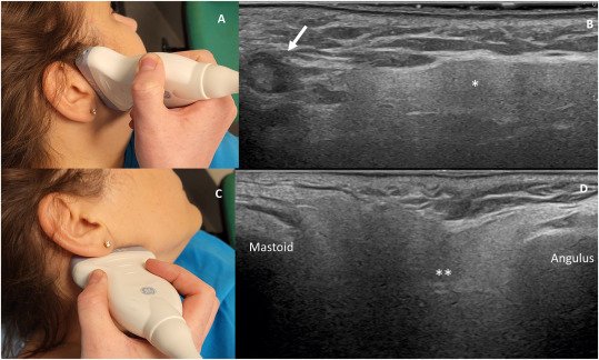 Superficial USG (Thyroid, Parotid, Sweling Etc)